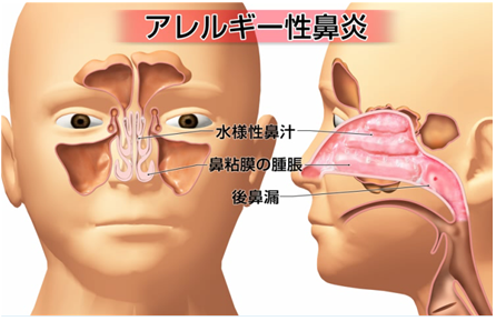 粘膜 痛い 鼻